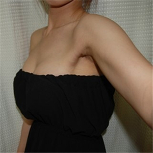 去年底做了自體脂肪豐胸手術，分享術后果照片~