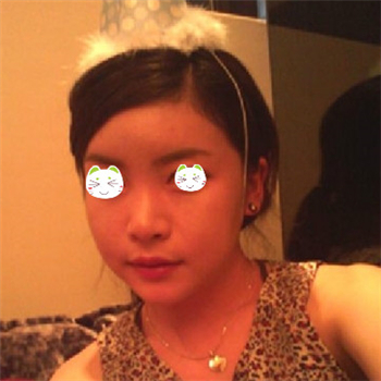 分享美立方做下頜角整形手術(shù)經(jīng)歷，還有前后對比果圖片哦~