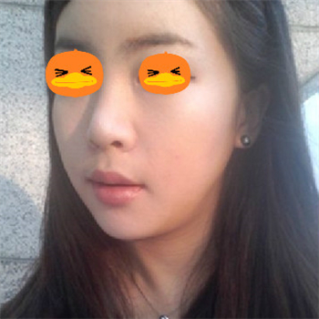 分享美立方做下頜角整形手術(shù)經(jīng)歷，還有前后對比果圖片哦~