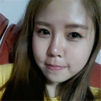 藝星做的玻尿酸去法令紋，分享恢復(fù)過程和前后對比照片~