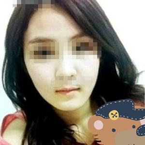 南相宰磨下頜角手術(shù)恢復(fù)過程分享，還有前后對比圖片哦~