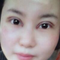 割雙眼皮和開內(nèi)眼角一起做了，護(hù)理了近一個(gè)月完全恢復(fù)自然