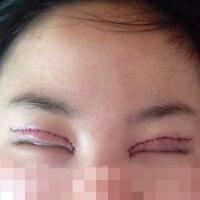 割雙眼皮和開內(nèi)眼角一起做了，護(hù)理了近一個(gè)月完全恢復(fù)自然