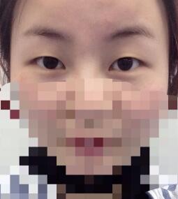 全切雙眼皮和開內(nèi)眼角手術(shù)恢復(fù)過程分享