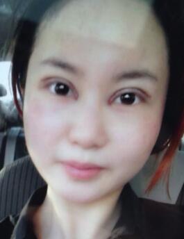 割雙眼皮整形圖片