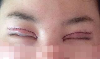 雙眼皮多項(xiàng)整形整形圖片