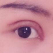 全切雙眼皮和開眼角