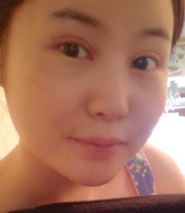 全切雙眼皮和開眼角半個(gè)月了