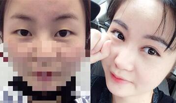 割雙眼皮和開眼角的手術(shù)果對(duì)比圖