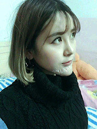 自體脂肪墊下巴前后手術(shù)過程以及對比恢復(fù)照片分享