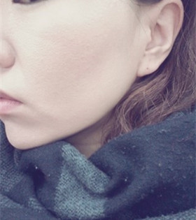 電波l皮緊膚除皺，的確是年輕了不少