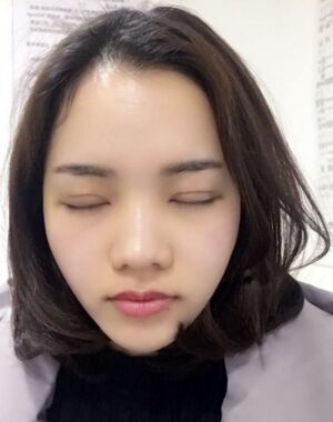 為了美麗大眼做了切開雙眼皮，果令我驚嘆