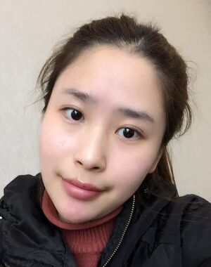 深圳美萊整形醫(yī)院做了進口硅膠墊下巴臉型都變好看了