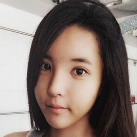 鷹鉤鼻矯正整形手術(shù)恢復(fù)過程和前后對比果圖片，分享給大家~