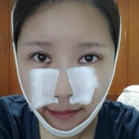 做了埋線雙眼皮、隆鼻、磨下頜角，兩個(gè)月了，分享恢復(fù)照片~