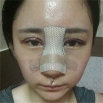 埋線雙眼皮+隆鼻手術(shù)恢復(fù)過程和前后對(duì)比果圖片真實(shí)分享~~~