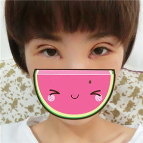 雙眼皮失敗修復手術(shù)前后對比果圖片分享，伊美馨做的哦·