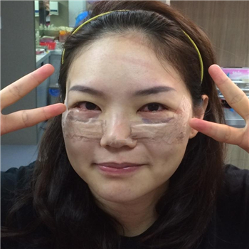 李阿姨眼袋失敗修復手術(shù)后的果圖，年輕了好幾歲~