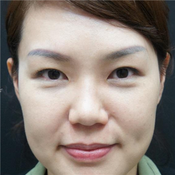 李阿姨眼袋失敗修復手術(shù)后的果圖，年輕了好幾歲~