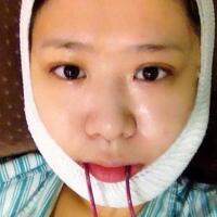 磨下頜角整形——恢復(fù)3個(gè)月后真實(shí)磨骨案例分享