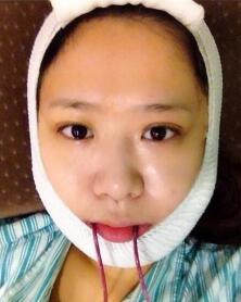 磨骨，下頜角整形照片