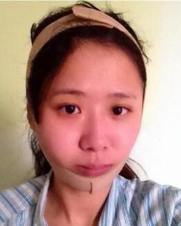 磨下頜角手術(shù)圖片