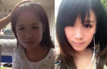 磨下頜角前后對(duì)比圖