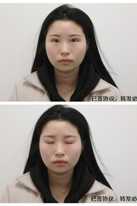 剛做了雙眼皮切開重瞼手術(shù)，恢復(fù)得越來越自然了