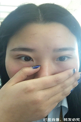 剛做了雙眼皮切開重瞼手術(shù)，恢復(fù)得越來越自然了