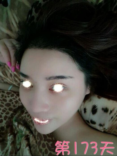 植發(fā)拯救了我的高發(fā)際線(xiàn) 果很棒哦**