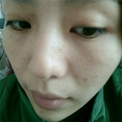光子嫩膚和下巴脂肪填充術(shù)后果圖片分享，董萍門診做的~