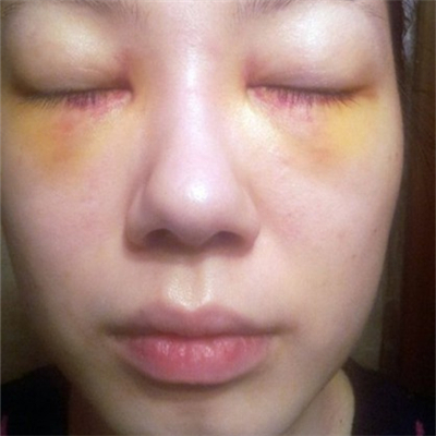 激光溶脂去眼袋恢復過程和前后對比果圖片分享哦~