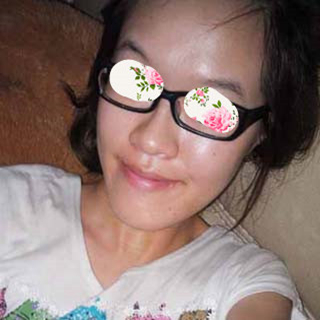 激光祛痘手術(shù)恢復(fù)過(guò)程分享，還有前后對(duì)比果圖片哦~