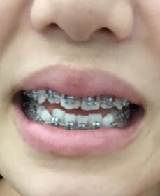 口腔正畸緩解圖片