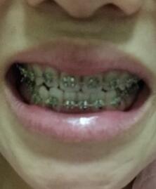 口腔正畸圖片