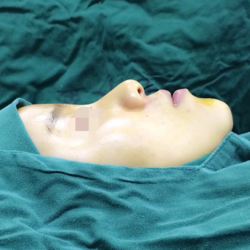 歪鼻矯正手術(shù)前后過(guò)程以及恢復(fù)照片對(duì)比照