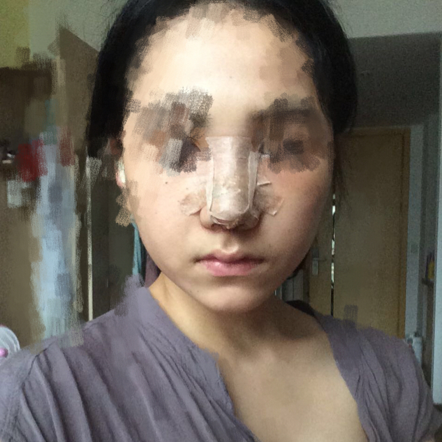 歪鼻矯正手術(shù)前后過(guò)程以及恢復(fù)照片對(duì)比照