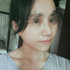 歪鼻矯正手術(shù)前后過(guò)程以及恢復(fù)照片對(duì)比照