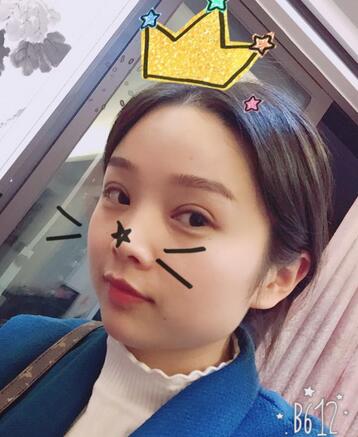 全切雙眼皮1個月過程圖