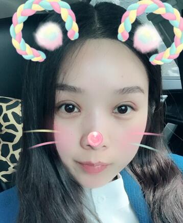 全切雙眼皮1個月過程圖