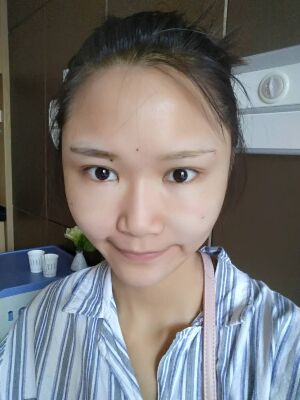 自體脂肪面部填充后恢復(fù)，成活率還蠻高的