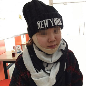 吸脂瘦臉手術(shù)半年了，分享前后對(duì)比果照片~