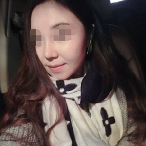 吸脂瘦臉手術(shù)半年了，分享前后對(duì)比果照片~