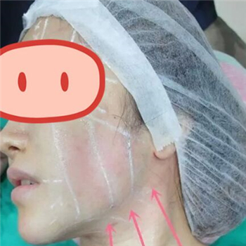 做音波拉皮除皺術(shù)一個(gè)月了，分享恢復(fù)過(guò)程和前后對(duì)比果圖片~