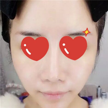 做音波拉皮除皺術(shù)一個(gè)月了，分享恢復(fù)過(guò)程和前后對(duì)比果圖片~