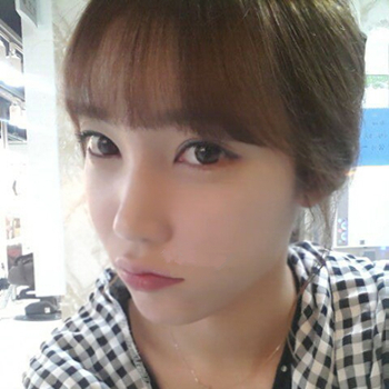 長(zhǎng)沙美萊做了磨顴骨手術(shù)，分享恢復(fù)過(guò)程和前后對(duì)比果圖片~