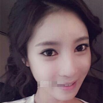 長(zhǎng)沙美萊做了磨顴骨手術(shù)，分享恢復(fù)過(guò)程和前后對(duì)比果圖片~