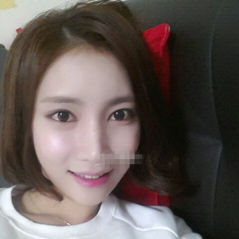 長(zhǎng)沙美萊做了磨顴骨手術(shù)，分享恢復(fù)過(guò)程和前后對(duì)比果圖片~