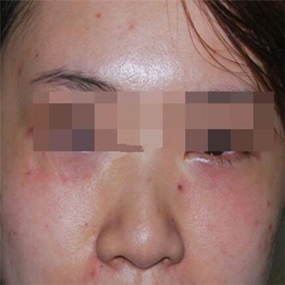 內(nèi)切去眼袋手術(shù)恢復(fù)過(guò)程和前后對(duì)比果圖片分享，美聯(lián)臣做的哦~