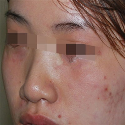 內(nèi)切去眼袋手術(shù)恢復(fù)過(guò)程和前后對(duì)比果圖片分享，美聯(lián)臣做的哦~